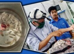 জীবন্ত মানুষের নাক থেকে বের হলো জীবন্ত ৮১ টি পোকা!